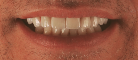 A teeth transformation showing straight teeth