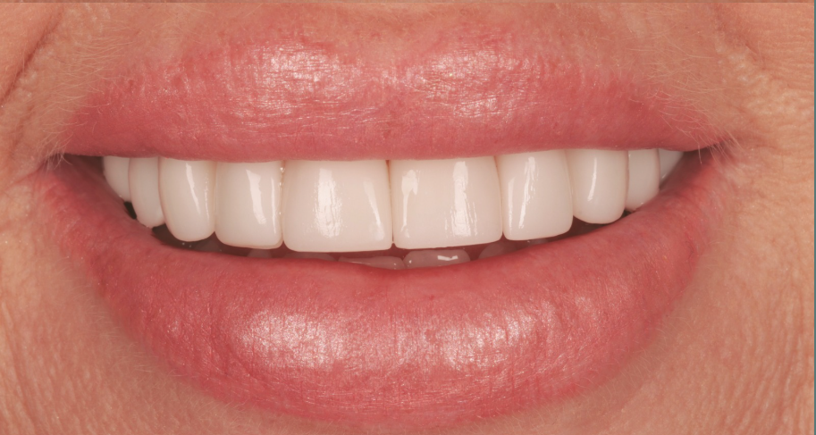 A smile of straight teeth