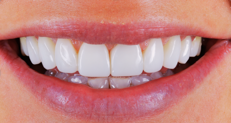 A smile with perfect teeth