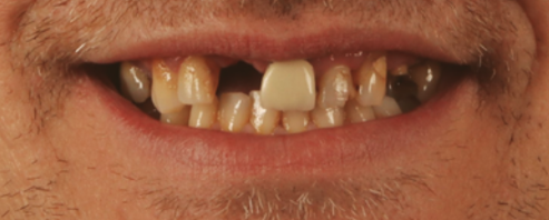 An image showing missing teeth