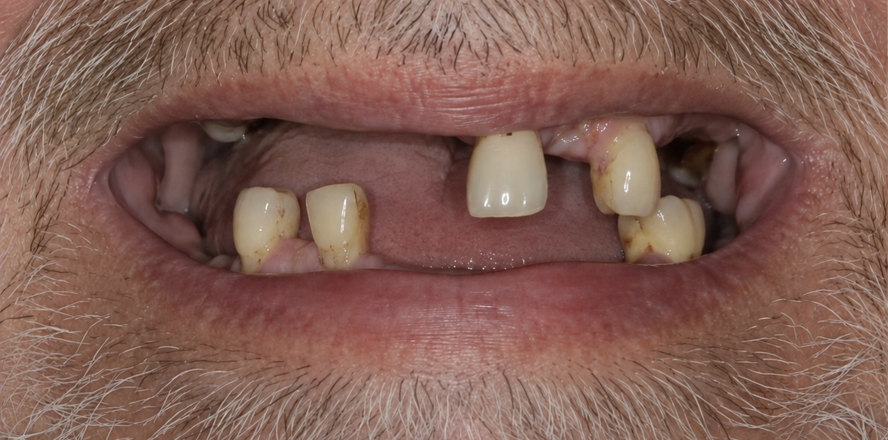 Person smiling with missing and stained teeth