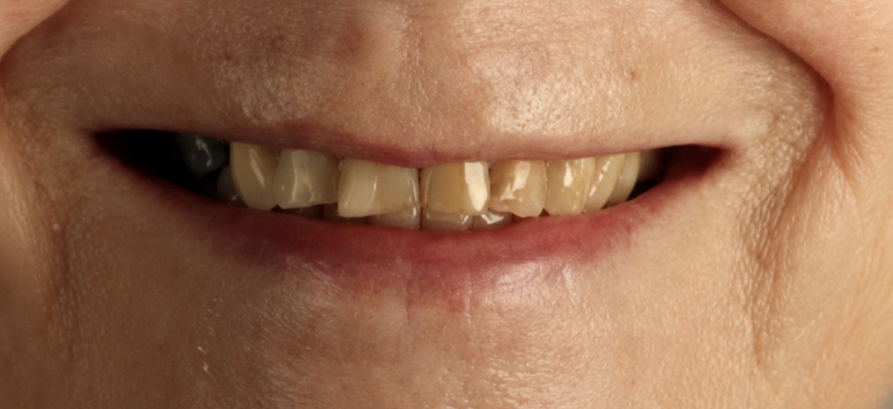 Person smiling with stained, misaligned teeth