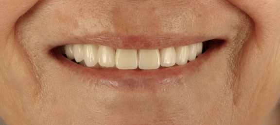 Person smiling with straight, white teeth