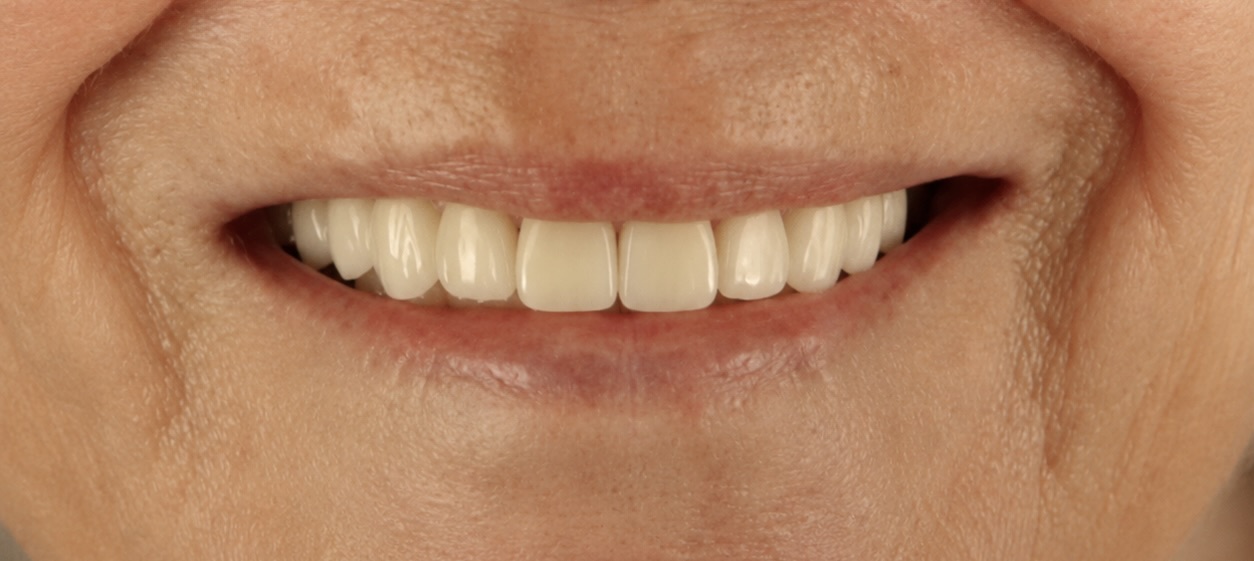 Person smiling with straight, white teeth