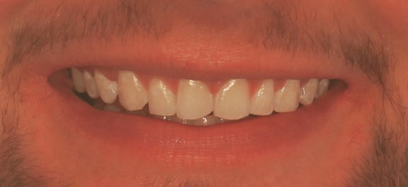 person smiling with straight white teeth