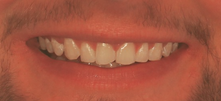 person smiling with straight white teeth