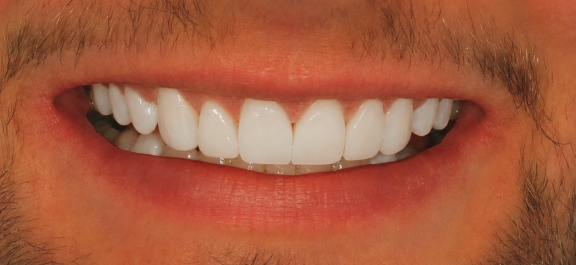 person smiling with straight white teeth
