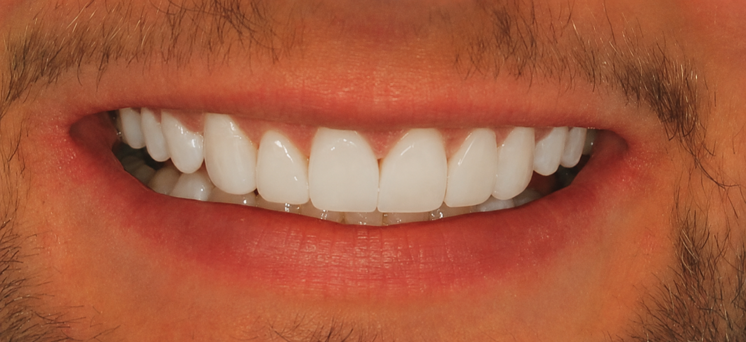 person smiling with straight white teeth