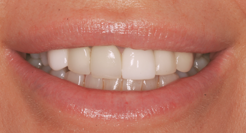person smiling with straight white teeth