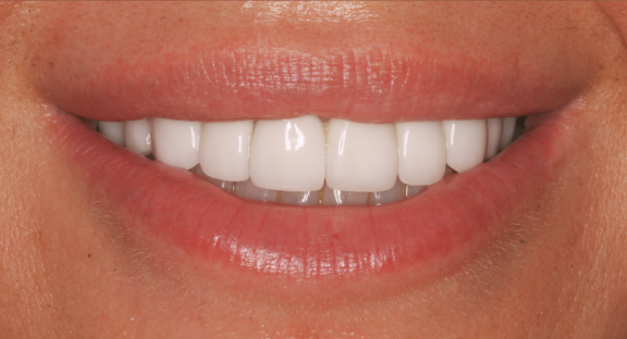 person smiling with straight white teeth