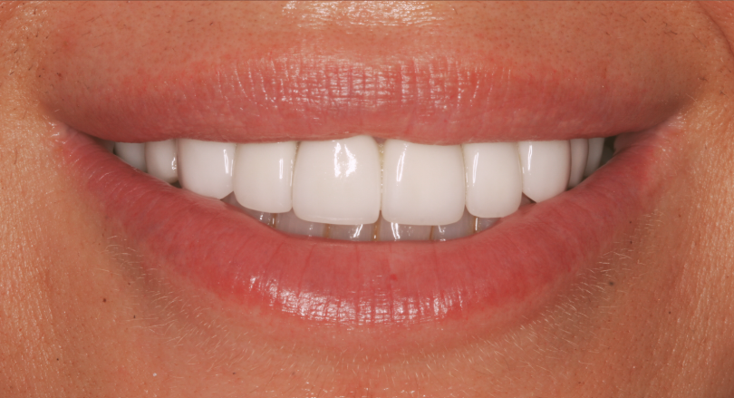 person smiling with straight white teeth