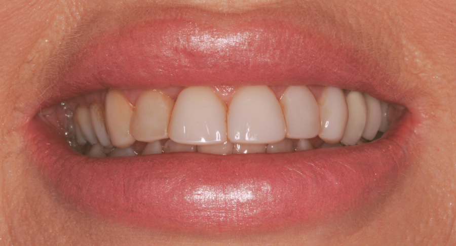 person smiling with slightly stained teeth
