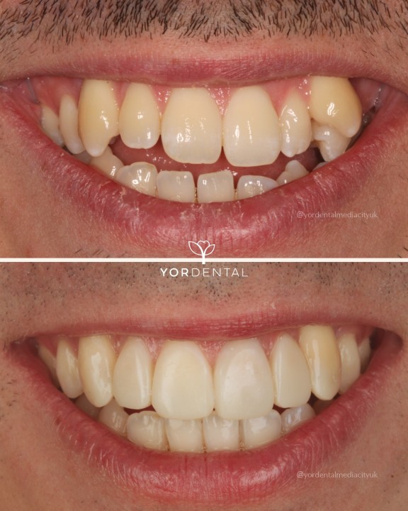 Invisalign and Spark Clear Aligners Before and After Smile Transformation YOR Dental Salford Quays Manchester